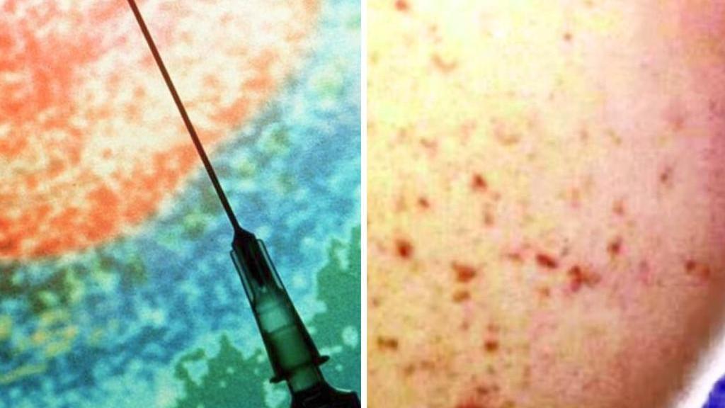 WA records first meningococcal death this year after only three reported cases in 2026
