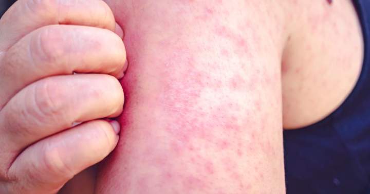 Canada’s 2-year measles outbreak officially over: PHAC – National